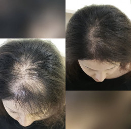 Hair Loss Solution